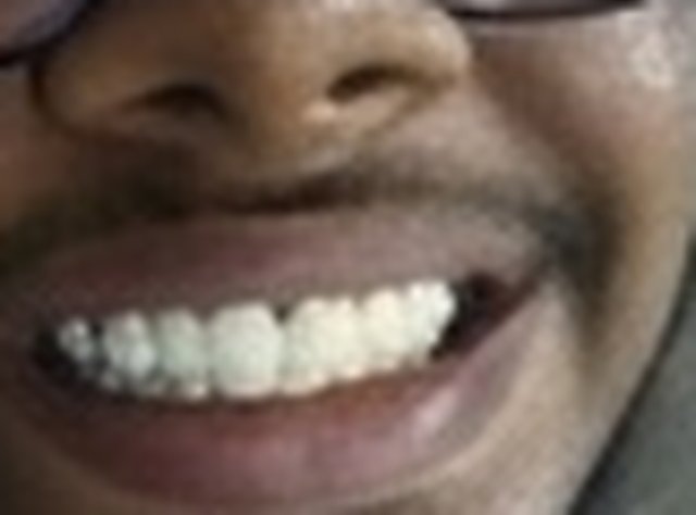After: smile reshaped with cosmetic bonding