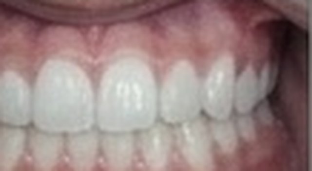 After: fractured tooth restored