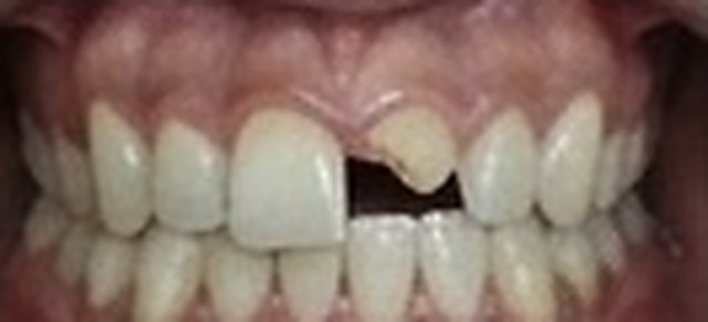 Before: fractured front tooth