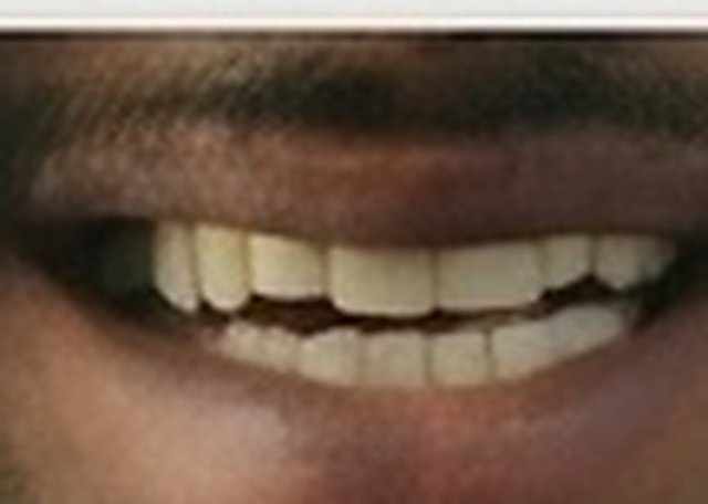 After: tooth rebuilt with composite bonding
