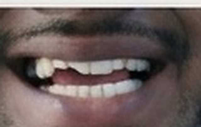 Before: broken front tooth
