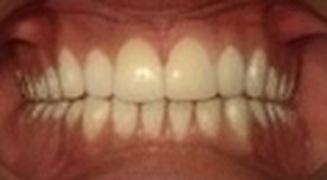 After: incisor gap closed and contoured