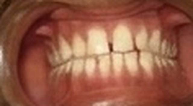 Before: gap between front incisors