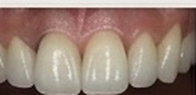 After: missing tooth replaced with an implant crown