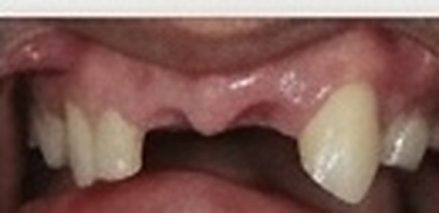 Before: missing front tooth