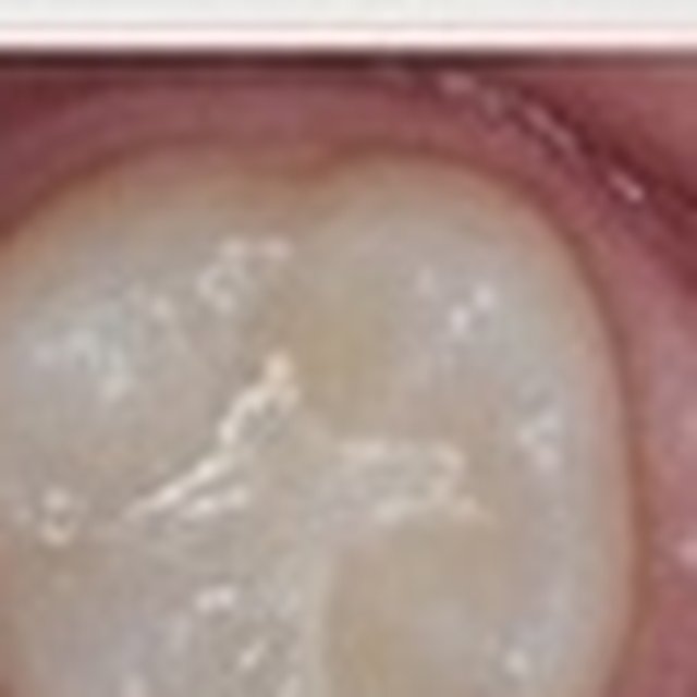 After: molar protected with a dental sealant