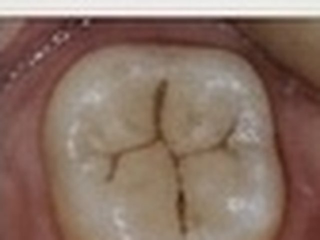 Before: deep grooves on a child's molar