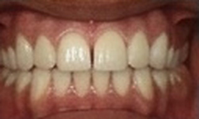 After: gap closed with porcelain veneers