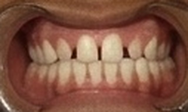 Before: gap between front teeth