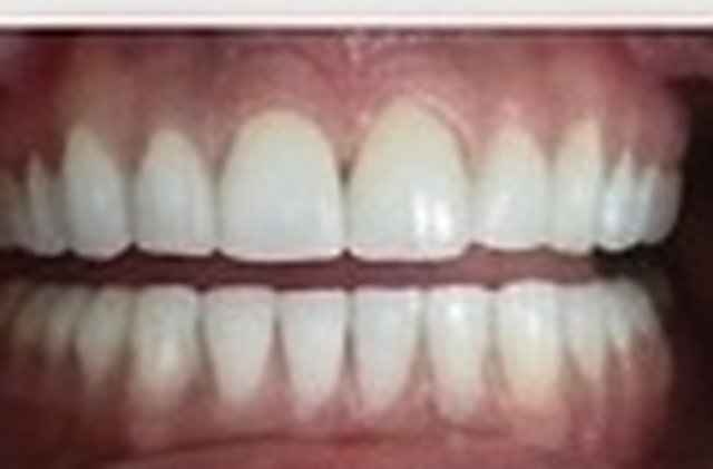 After: brighter teeth following professional whitening