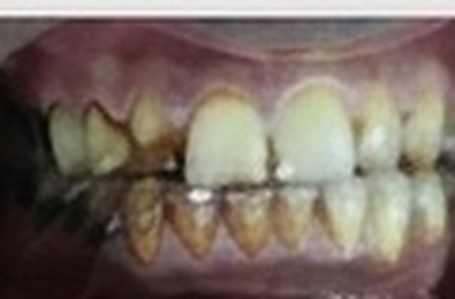 Before: discoloured teeth